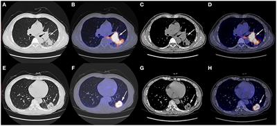 Case Report: Pathologic Complete Response to Pembrolizumab in Combination With Neoadjuvant Chemotherapy in a Patient With Stage IIB Squamous Lung Cancer